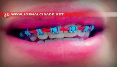 "Moda" do aparelho falso pode danificar dentes e tecidos bucais