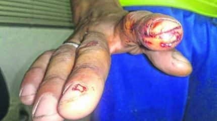 Coletores de lixo exibem ferimentos resultantes do contato com materiais perfurocortantes descartados no lixo doméstico