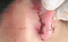 A jovem Jennifer Inácio, de 17 anos, levou 18 pontos na orelha após ter sido atingida por linha de pipa contendo cerol