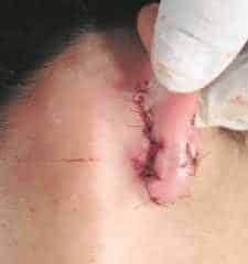 A jovem Jennifer Inácio, de 17 anos, levou 18 pontos na orelha após ter sido atingida por linha de pipa contendo cerol