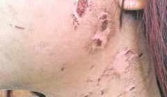 Menina de apenas 16 anos foi agredida pelo companheiro. Rapaz irá responder pelo crime de tortura