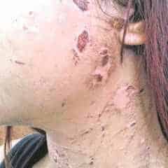 Menina de apenas 16 anos foi agredida pelo companheiro. Rapaz irá responder pelo crime de tortura