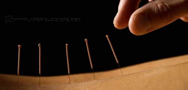 Método de terapia gerado da clássica medicina da China, a acupuntura é uma das práticas medicinais mais antigas de toda a história