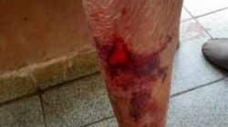 Lesões que idosa sofreu durante o ataque sexual