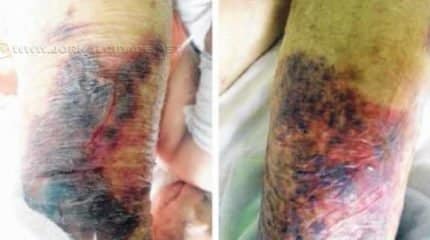 Após ser colocada em maca por profissionais da Saúde, idosa de 80 anos acabou caindo. Sindicância foi instaurada pela Fundação Municipal de Saúde