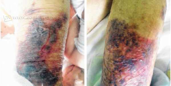 Após ser colocada em maca por profissionais da Saúde, idosa de 80 anos acabou caindo. Sindicância foi instaurada pela Fundação Municipal de Saúde