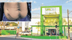 No caso registrado em 2019, o paciente se dirigiu à Unidade de Pronto Atendimento (UPA) da Avenida 29, com fortes dores abdominais. No entanto, dias depois precisou passar por cirurgia de emergência.